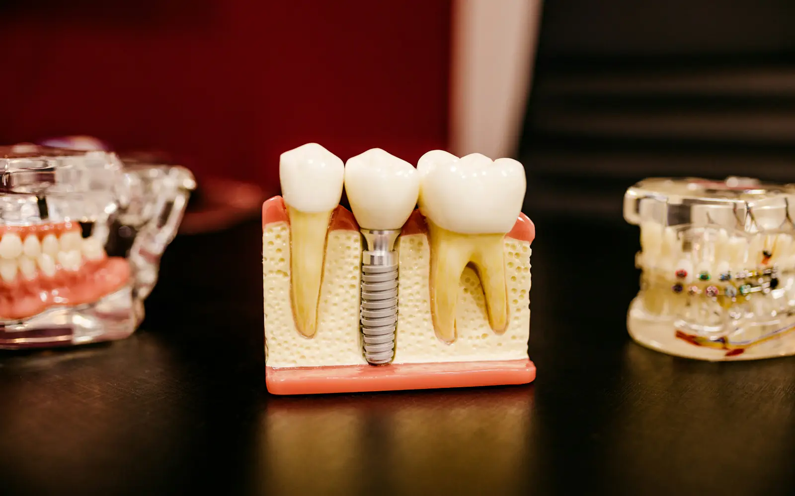 A dental model showing an implant screw between two natural teeth, with other dental models nearby.